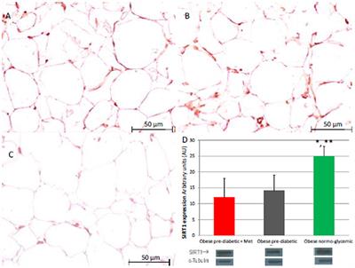 Inflammatory Cytokines and SIRT1 Levels in Subcutaneous Abdominal Fat: Relationship With Cardiac Performance in Overweight Pre-diabetics Patients